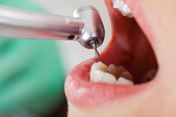Best Emergency Treatment for Dental Infections or Abscesses in Winton, CA